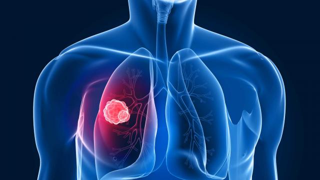 中年人患肺癌会有哪些症状